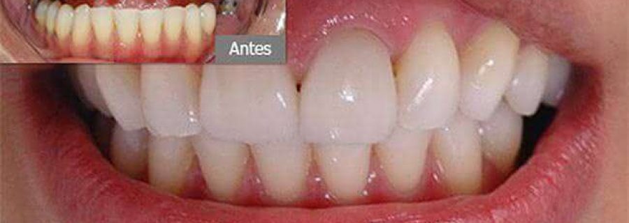 protese-dentaria-fixa-2